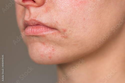 Young Caucasian woman suffering from perioral dermatitis near the mouth. Close up photo. Skin problems. Dermatology. Skin diseases.