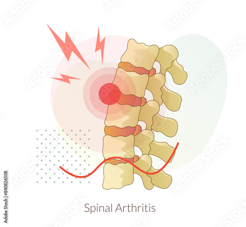 Backache - Spinal Arthritis- Stock Icon