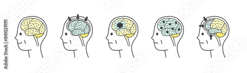 高齢者が認知症によって損傷を受ける脳の部分のイラストのセット