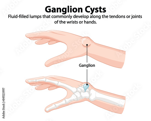 Illustration of ganglion cysts on wrist and hand