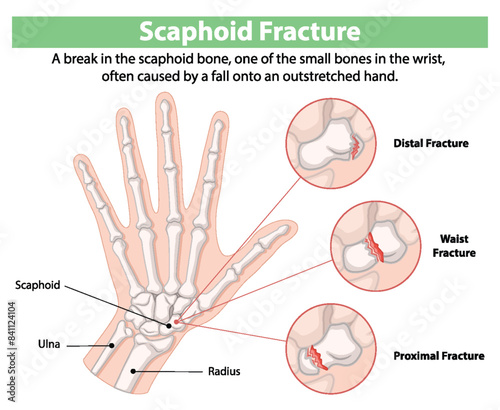 Illustration of scaphoid bone fractures in the wrist