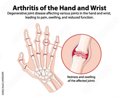 Degenerative joint disease affecting hand and wrist joints