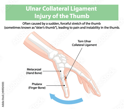 Detailed diagram of thumb ligament injury