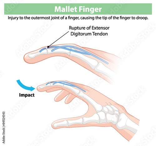 Depicts rupture of extensor digitorum tendon