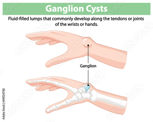Illustration of ganglion cysts on hands and wrists