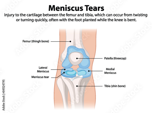 Illustration of knee meniscus tear anatomy