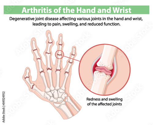 Degenerative joint disease affecting hand and wrist