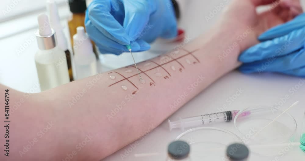 Allergy skin tests and prick test on patient skin in clinic Stock ビデオ ...