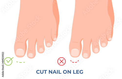 How to cut toenails correctly so that pain does not occur. Treatment and care of problem nails. Vector illustration