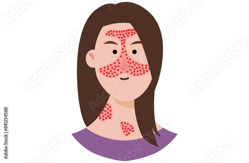 Discoid lupus erythematosus is a chronic skin condition causing red, inflamed, scaly patches. Similar diseases include systemic lupus erythematosus ,sick, subacute cutaneous lupus, and lichen planus.