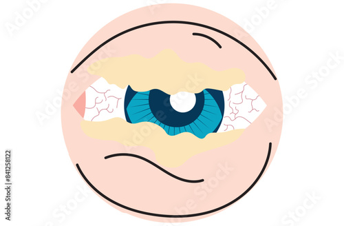 Mucous membrane pemphigoid,Cicatricial,chronic autoimmune causing blistering and scarring of the mucous membranes, including the eyes,Stevens-Johnson syndrom,ocular,Mooren's ulcer,vectors