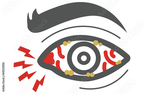 Mucous membrane pemphigoid,Cicatricial,chronic autoimmune causing blistering and scarring of the mucous membranes, including the eyes,Stevens-Johnson syndrom,ocular,Mooren's ulcer,vectors
