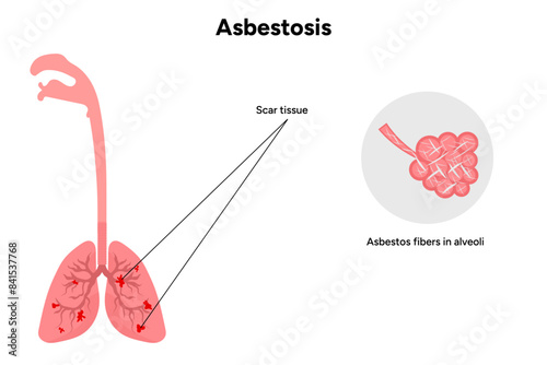 Asbestos-related diseases