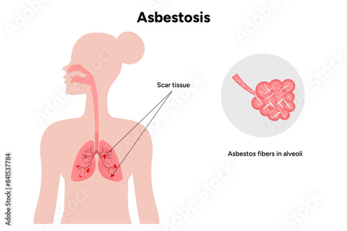 Asbestos-related diseases