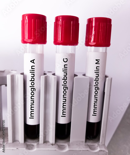Blood sample for Immunoglobulin A, G and M test at medical laboratory. photo