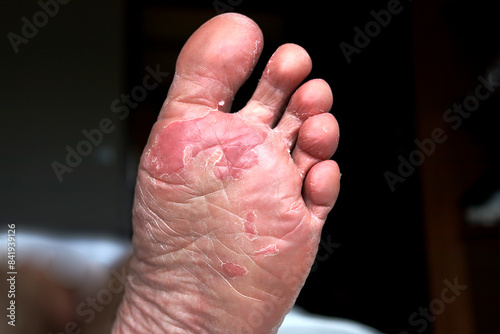 Close up of dry feet. Peeling and cracked foot. Fungal infection or athlete's foot, dry skin, dermatitis, eczema, psoriasis, sweaty feet or dehydration. Health care concept.