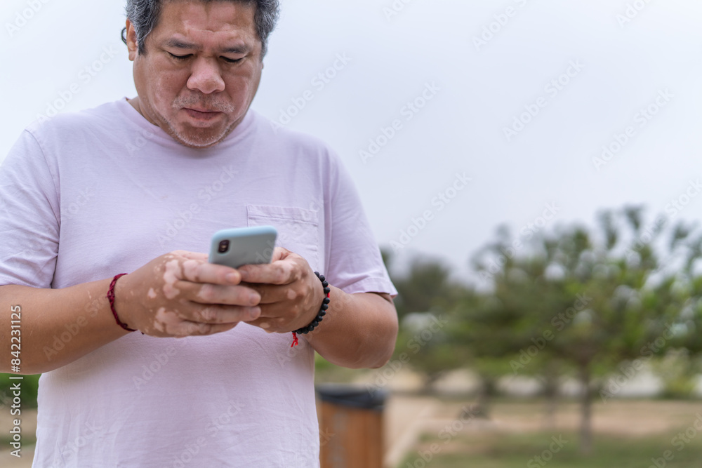 Fototapeta premium Man with vitiligo using cellphone standing on a park
