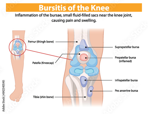 Diagram showing inflamed bursae in the knee joint