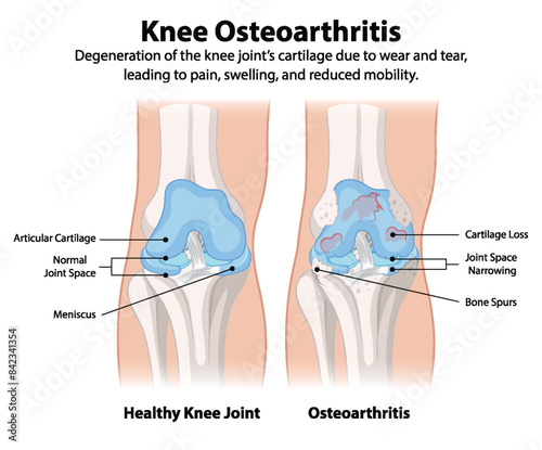 Healthy knee vs osteoarthritis-affected knee diagram