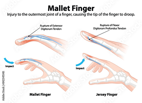 Illustration of finger tendon injuries and impacts