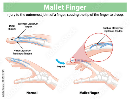 Diagram showing normal and mallet finger conditions
