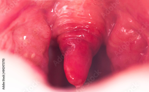 Uvulitis and sore throat in the oral cavity due to illness. Inflammation of the uvula and tonsils due to infections during illness, close-up, streptococcus