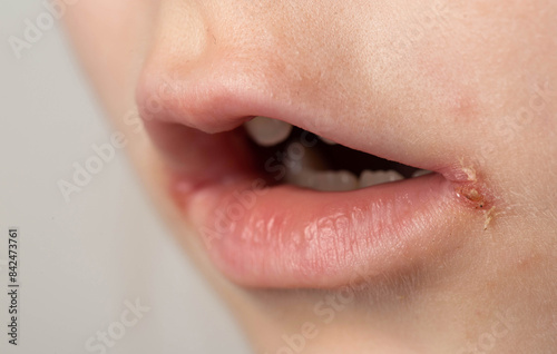 slit-like impetigo in a little girl in the corners of her mouth. Skin wounds. Dermatological bacterial disease. Sticky lips, close-up, angulitis