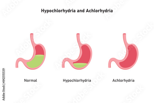 Hypochlorhydria and Achlorhydria Scientific Design. Vector Illustration.