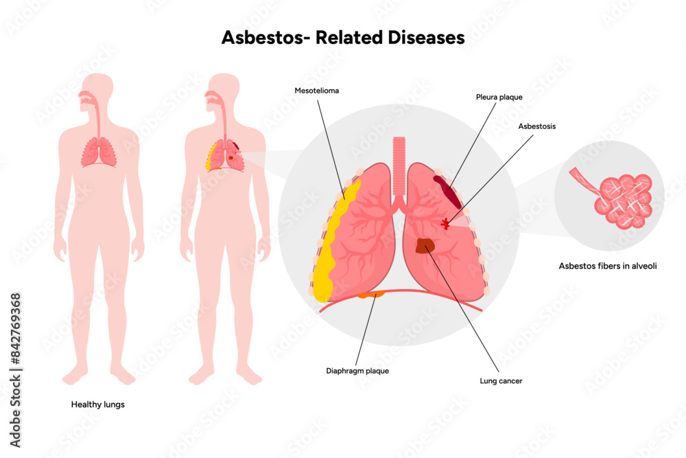 Obraz premium Asbestos-related diseases