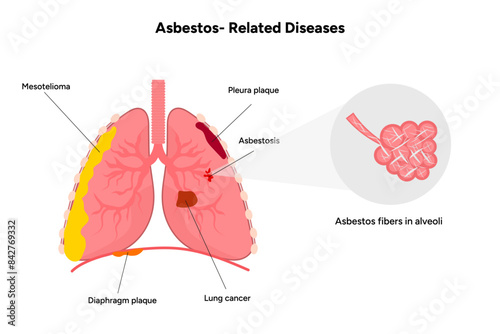 Asbestos-related diseases lungs problem