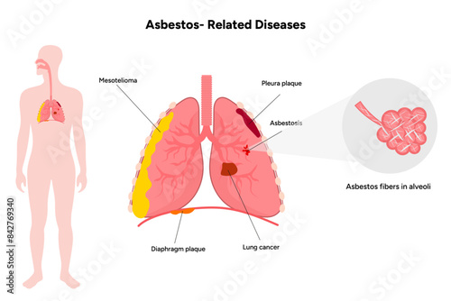 Asbestos-related diseases lungs problem
