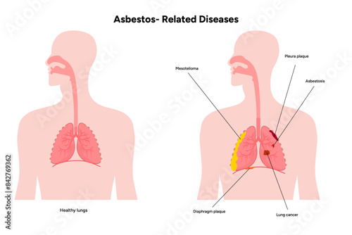 Asbestos-related diseases lungs problem
