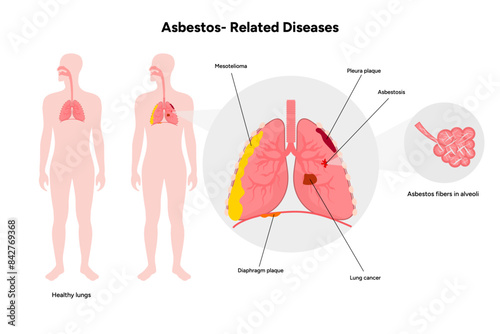 Asbestos-related diseases