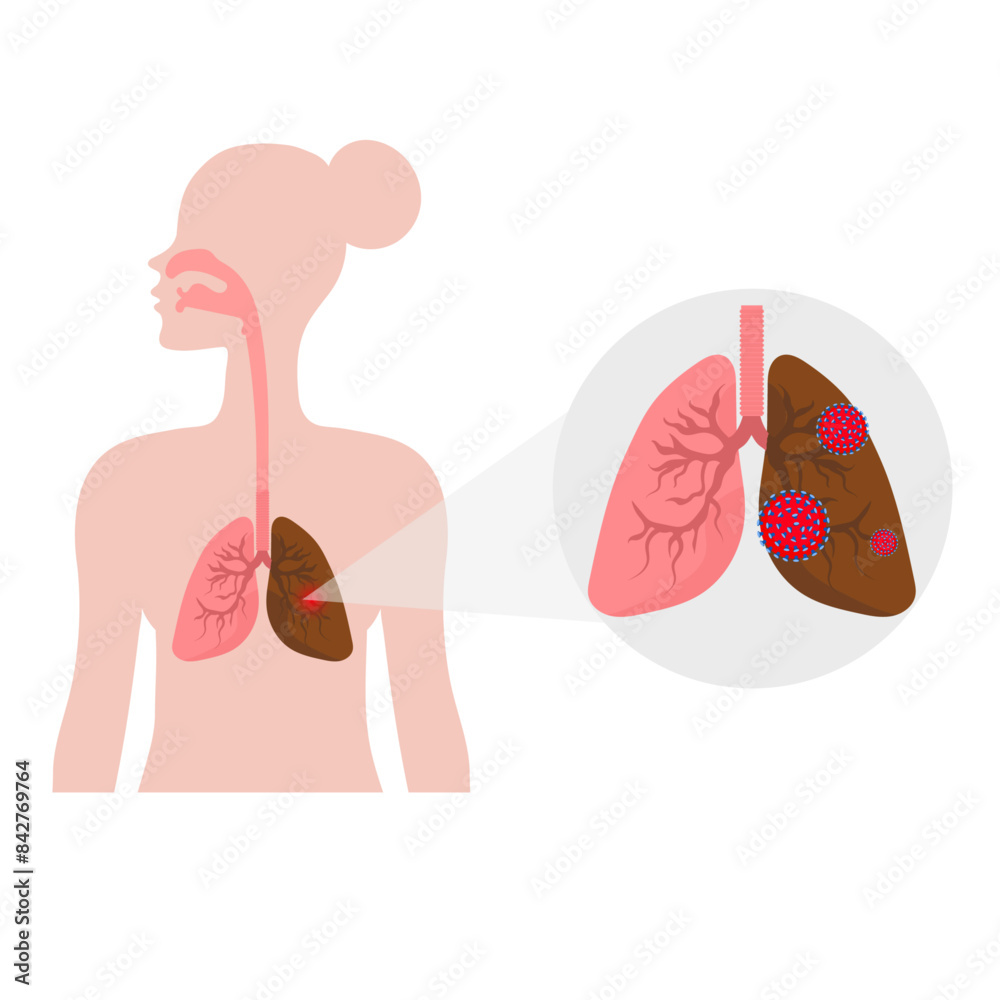 Lungs dieses and lungs problem, virus and infection Lungs dieses and lungs problem, virus and infection