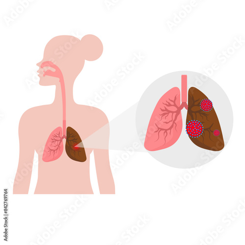 Lungs dieses and lungs problem, virus and infection 