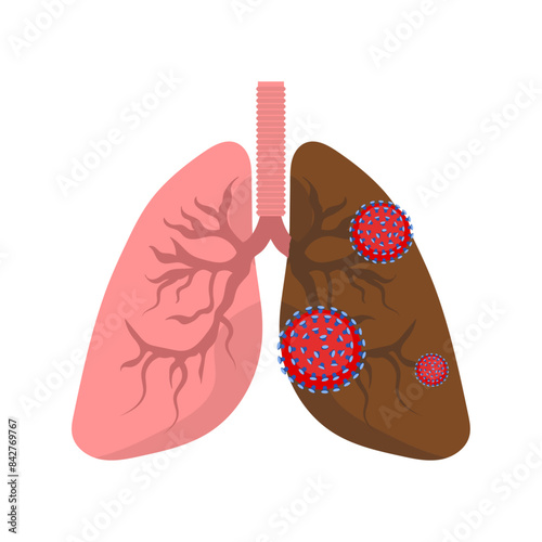 Lungs diseases and lungs problem virus and infection