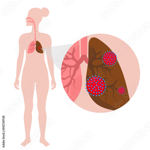 Lungs diseases and lungs problem virus and infection