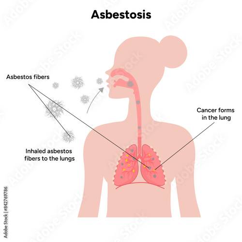 Asbestosis lungs diseases, lungs problem