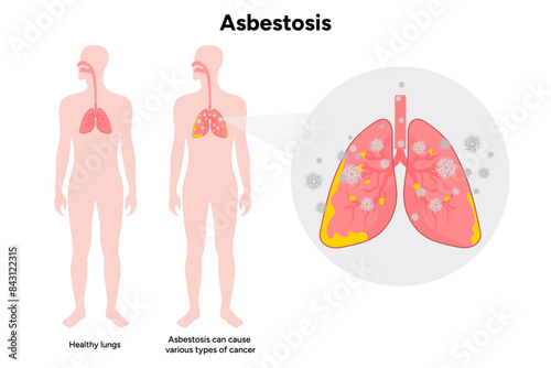 Asbestosis lungs diseases, lungs problem