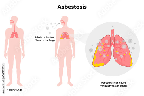Asbestosis lungs diseases, lungs problem