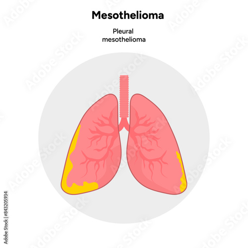 Mesothelioma disease,  Pleural mesothelioma, 