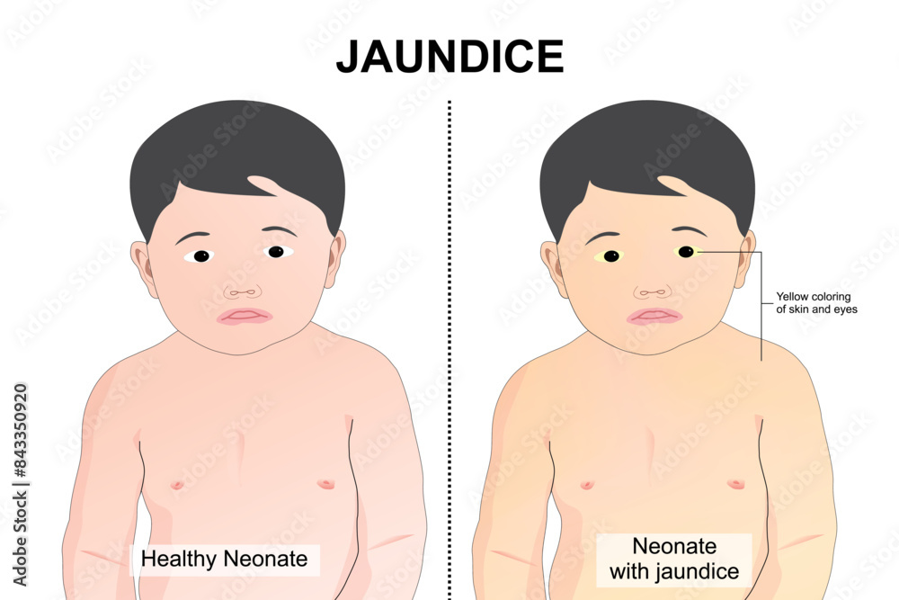 Neonate with jaundiced newborn Neonate with jaundiced newborn