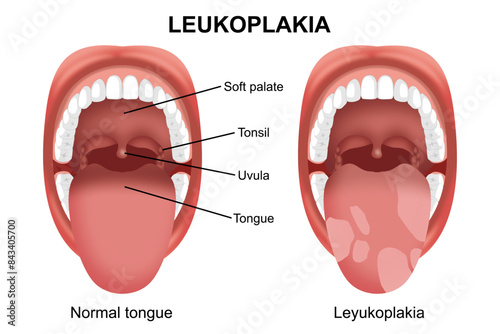 Normal tongue vs Leukoplakia mouth infection illustration