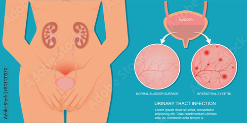 Urinary tract infection is a very common type of infection in urinary system.