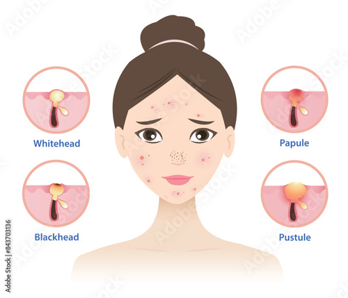 Types of acne on woman face vector illustration isolated on white background. Icon set of acne pimple, whitehead, blackhead, papule and pustule. Skin care and beauty concept. photo