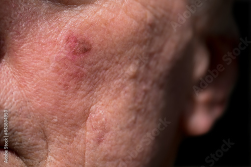 Red crusty lesions of actinic keratosis or sunspots on sun-damaged skin on the cheek under the left eye in the face of a man. This can be treated with cryosurgery or ointments