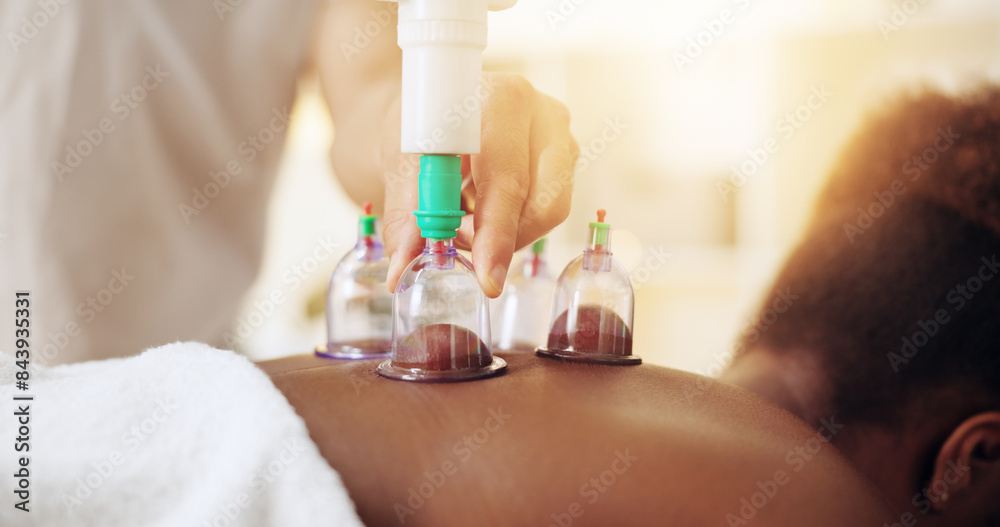 Cupping, therapy and woman at spa to relax for back pain, healing or holistic treatment. Calm, wellness and hands of chiropractor with female patient for massage with glass acupuncture jars in clinic Cupping, therapy and woman at spa to relax for back pain, healing or holistic treatment. Calm, wellness and hands of chiropractor with female patient for massage with glass acupuncture jars in clinic