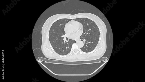 normal  chest Ct scan  lung window