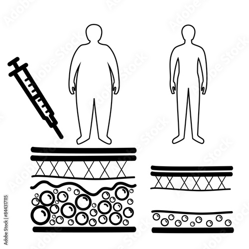 liposuction surgery, silhouette before and after procedure. Remove fat from obese body. Obesity problem. Overweight concept. Skin layers structure. Cannula. liposuction aspirate Vector illustration