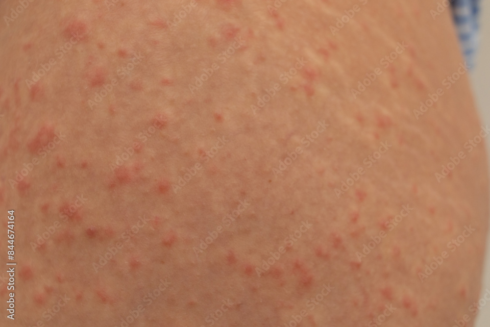 Urticaria allergy on woman legs Urticaria allergy on woman legs